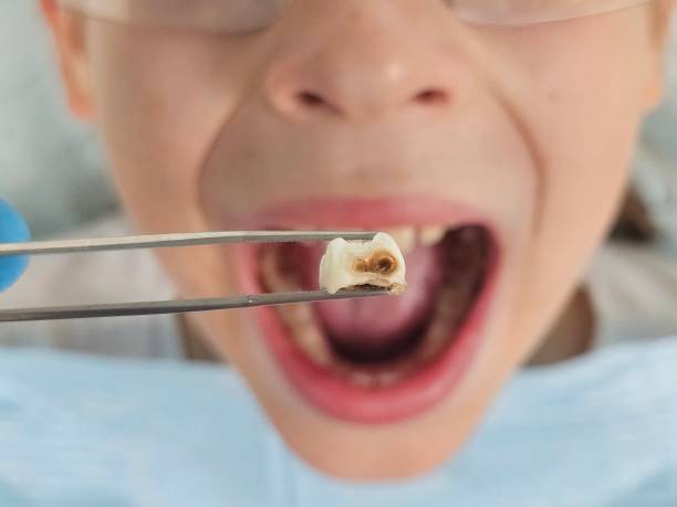 Best Emergency Tooth Extraction in Hilliard, FL